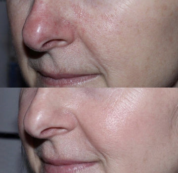 BEFORE & AFTER : <em><strong>THE MOXI/BBL COMBO</strong></em>